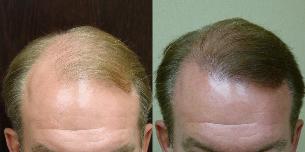 Male Hair Restoration in Savannah Georgia