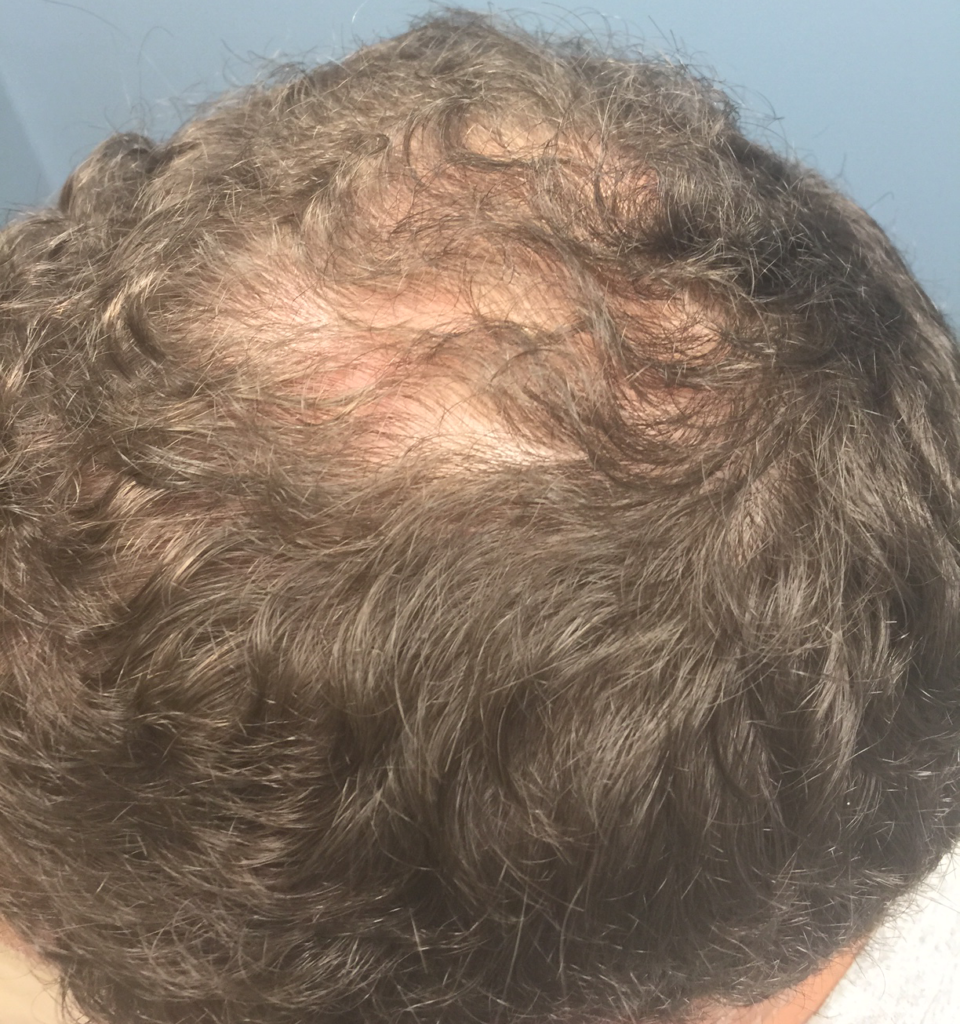 24 year old prp patient with hair loss