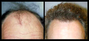 NeoGraft hair Restoration results