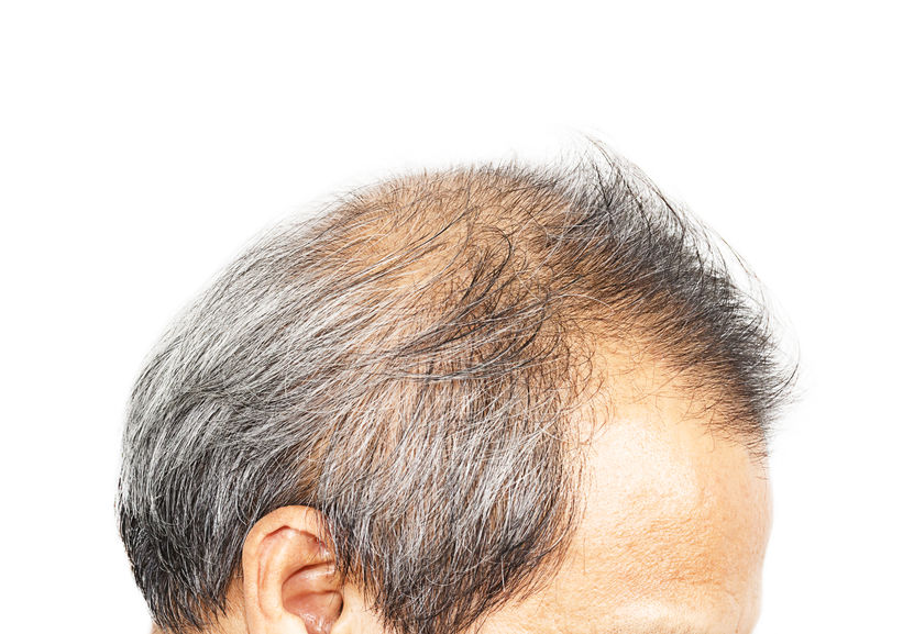 DHT and hair restoration