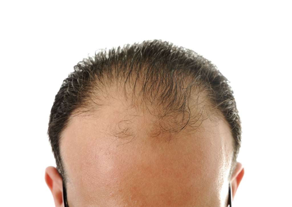 HAIR LOSS SOLUTIONS FOR THE YOUNG AND THE NOT SO YOUNG! Hair