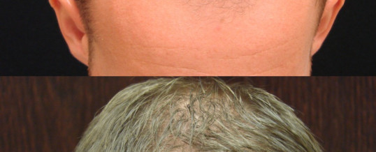 WHY NEOGRAFT HAIR TRANSPLANT?