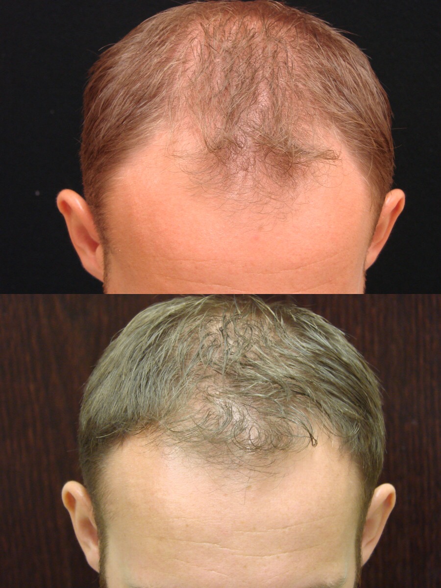 Various Hair Transplant Uses. WHY NEOGRAFT HAIR TRANSPLANT?