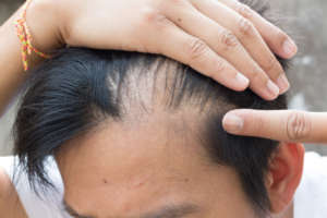 Neograft hair restoration