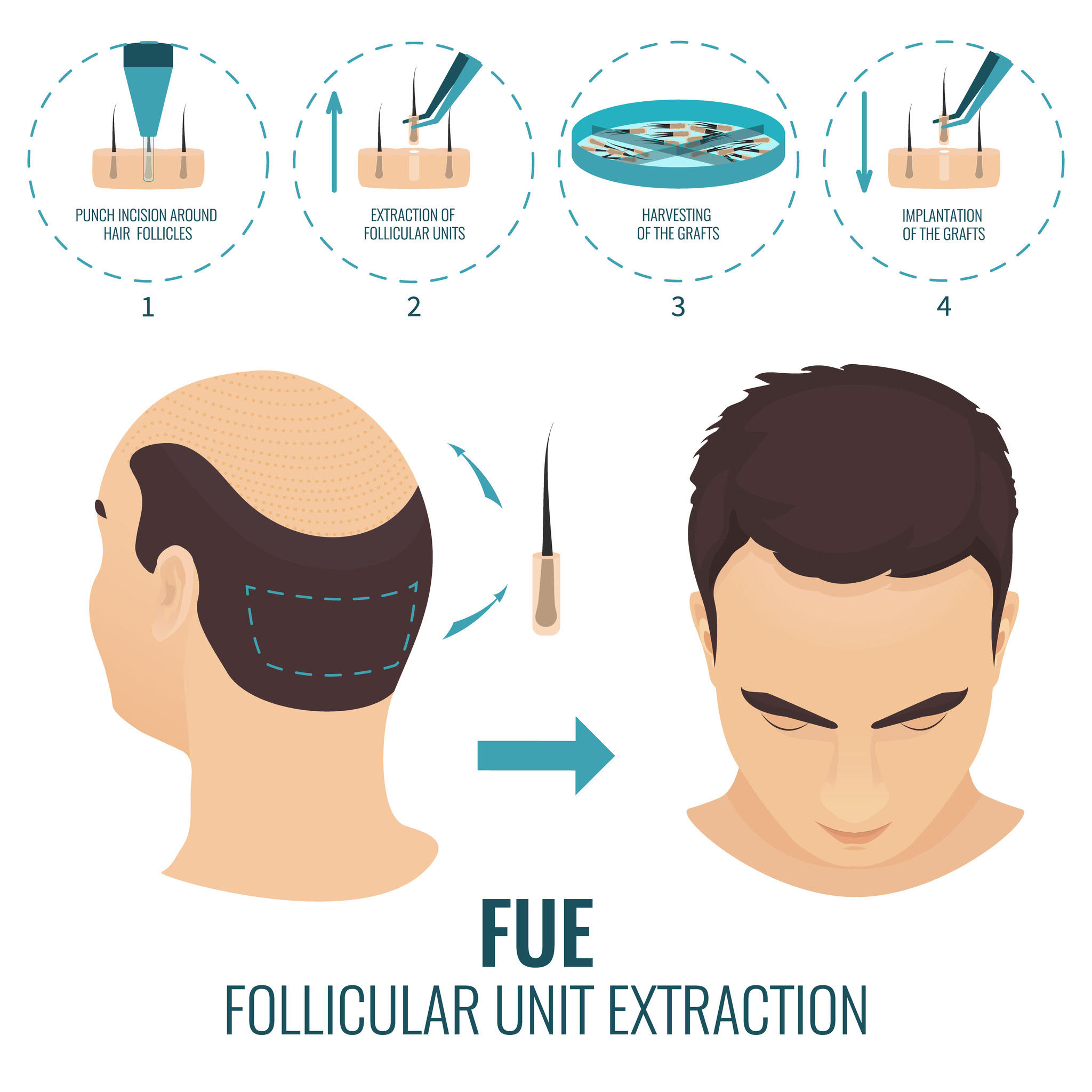 hair restoration method