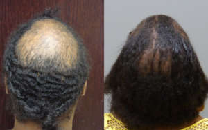 - Before and after 12-month 4050 grafts and scalp reduction.