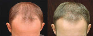 Gallery of real patients - Hair Restoration Savannah offers Hair Loss Solutions - 26 yr old, 1,050 grafts, 5 months after