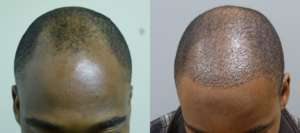 34 year old, frontal hairline, 2,000 grafts immediately after