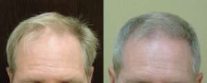 Hair Transplant Results of a 43 yr old, 1,533 grafts placed on front hair line and crown, 6 months after