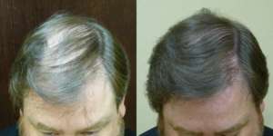 46 year old, 2,379 grafts, one year after