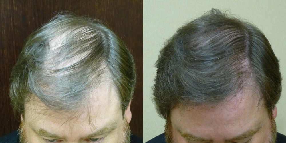 Hair Transplantation Savannah Georgia- Hair Restoration Savannah