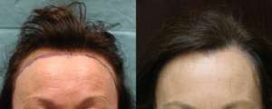 PRP Therapy for Hair Loss and Strip Method of Hair Restoration - 49 year old, 1,877 grafts to hair line, 1 yr after