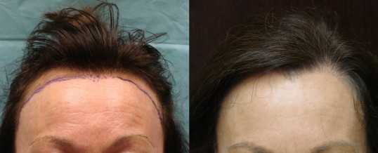 Various Hair Transplant Uses