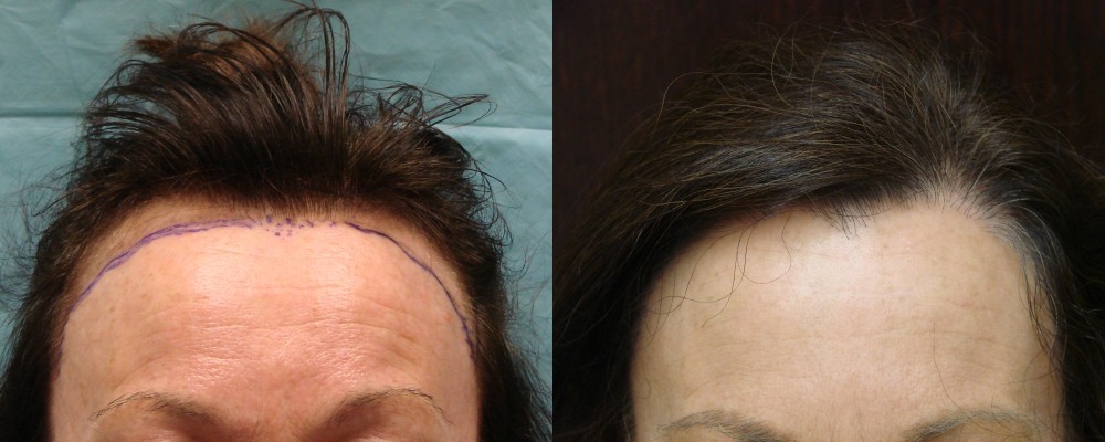 49 year old, 1,877 grafts to hair line, 1 yr after