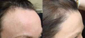 49 year old, 1,877 grafts to hair line, 1 yr after