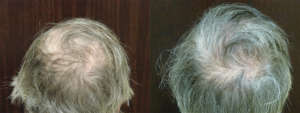 56 year old, 2,518 grafts to hairline and crown, one year after