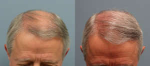 65 Year old, 2010 grafts placed on front hair line, one year after