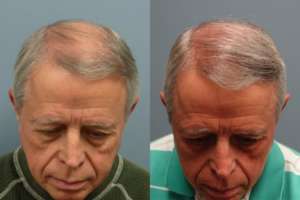 65 Year old, 2010 grafts placed on front hair line, one year after