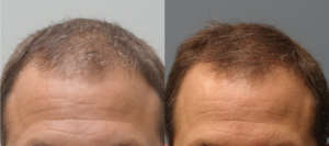 Hair Transplant Results with NeoGraft Before and After 3 months - NeoGraft 1200 grafts - Treating Hair Loss