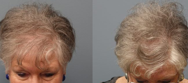 Female Hair Loss is very common especially in older women. Hair Transplant with strip excision, 69 year old, 1,500 grafts, Before and 11 months after
