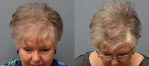 Hair Transplant 69 year old, 1,500 grafts, Before and 11 months after