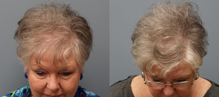 Hair Transplant 69 year old, 1,500 grafts, Before and 11 months after