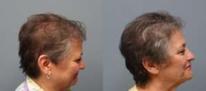 Hair transplant with strip excision 66 year old 1,325 Grafts Before and 11 months after