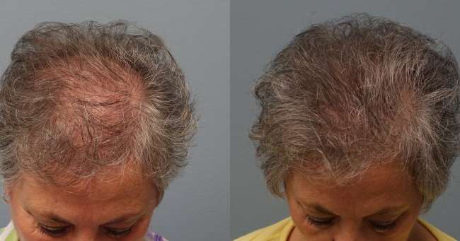 Hair transplant with strip excision 66 year old 1,325 Grafts Before and 11 months after
