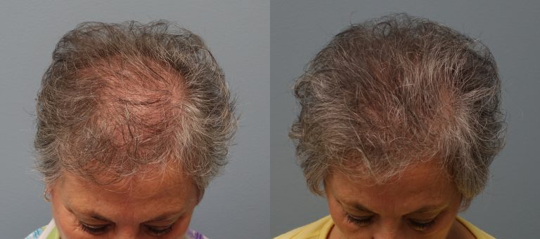 Hair transplant with strip excision 66 year old 1,325 Grafts Before and 11 months after