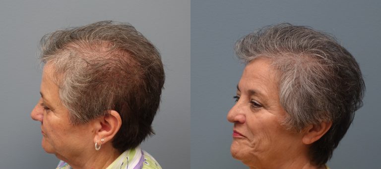 Hair transplant with strip excision 66 year old 1,325 Grafts Before and 11 months after