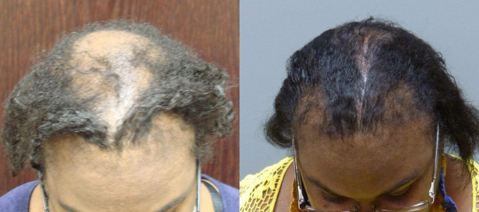 Hair Transplant Results with NeoGraft. Patient had Scalp Reduction and 4050 grafts total. 