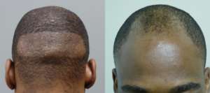 34 year old FUE 2000 grafts 1st picture shows donor site and his before 2nd shows 11 days after and 4 months after