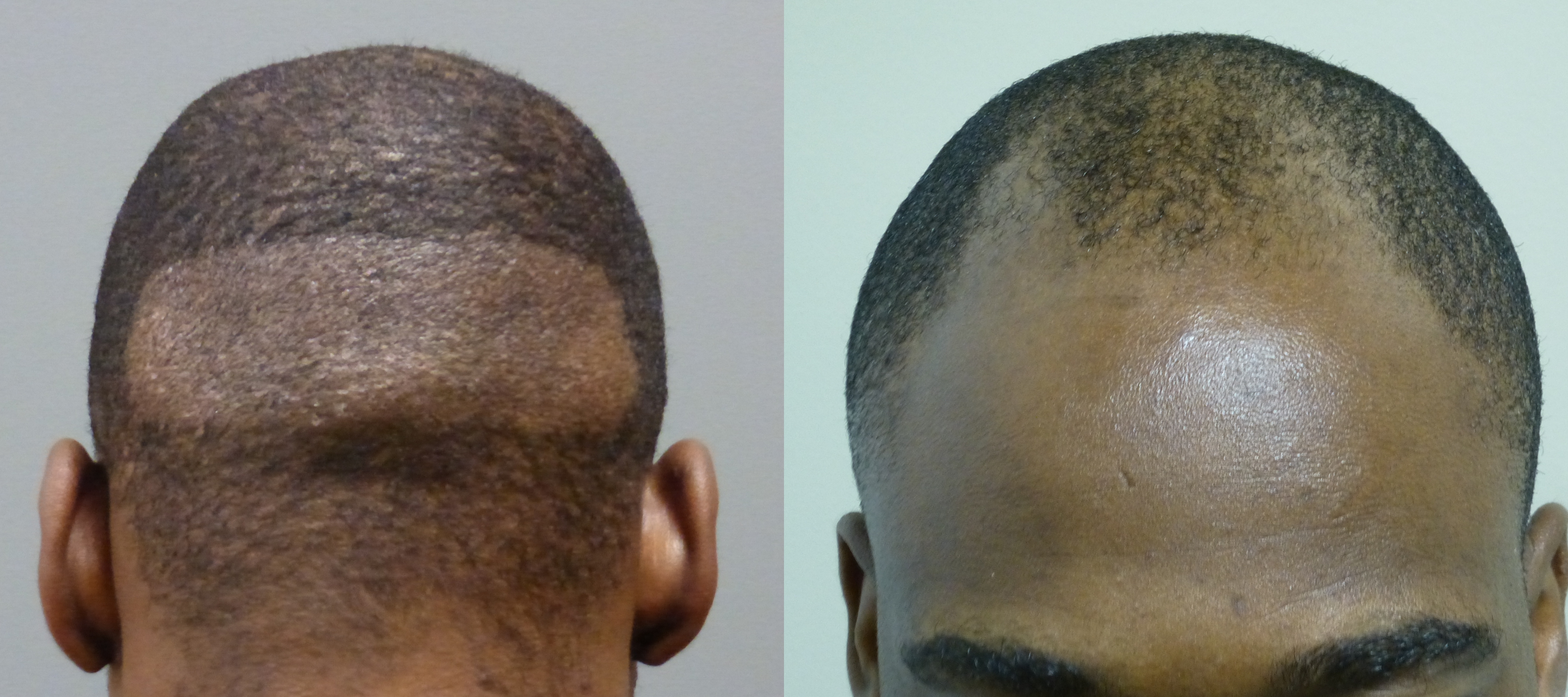 34 Year Old Fue St Picture Shows Donor Site And His Before 2nd Shows 34 Year Old Fue St Picture Shows Donor Site And His Before 2nd Shows