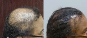 70 year old Female Before and After 12-months 4050 grafts and scalp reduction. Hair Transplants Results by Dr. E. Ronald Finger in Savannah