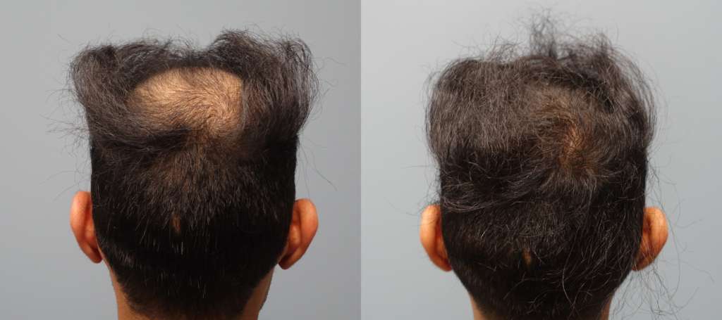Hair Restoration Savannah 1 Neograft Provider Fue And Fut