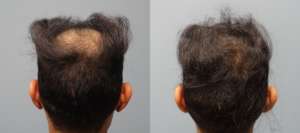 Hair Restoration Savannah offers multiple solutions for hair loss in men and women. This 33 year old male, 2,500 Grafts before and 4 months after.
