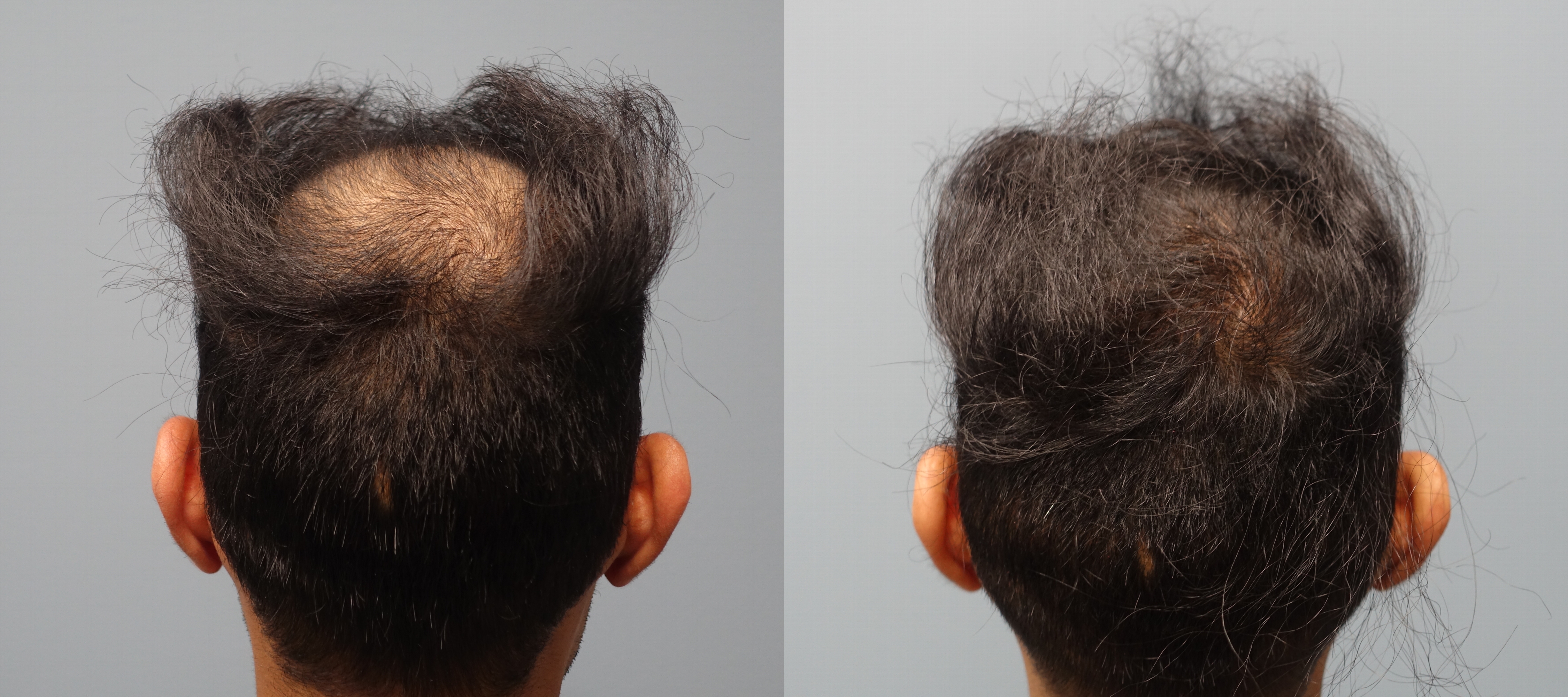 Hair Restoration Savannah 1 Neograft Provider Fue And Fut