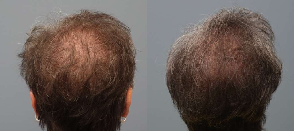Hair Restoration Methods include the Strip Method