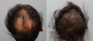 33 year old male, 2,500 Grafts before and 4 months after. Great Hair Transplants Results