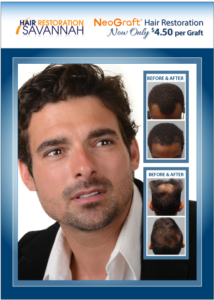 Neograft Hair Restoration Now Only $4.50 Per Graft