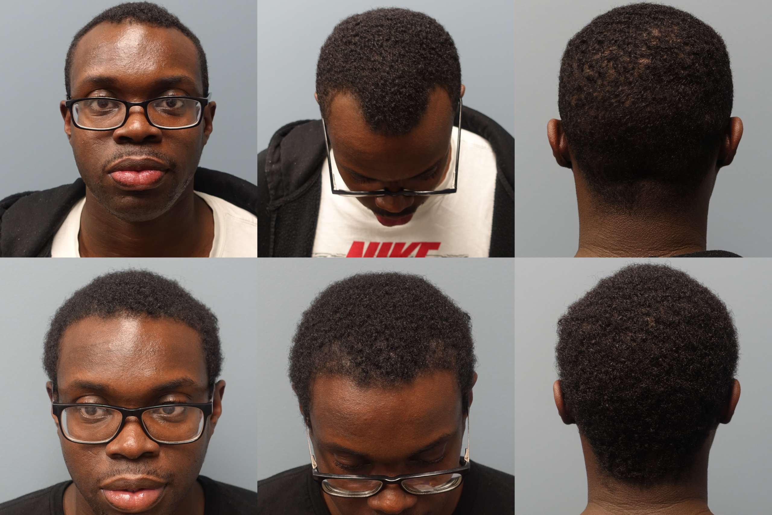 African Americans can benefit from Neograft Hair Restoration - The no linear Scar Method of hair transplantation