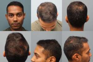 After Neograft Hair Transplant