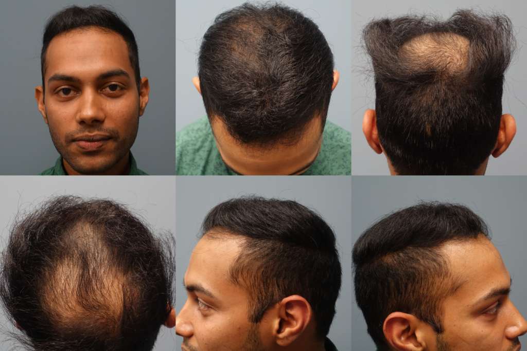 Hair transplants performed at Hair Restoration Savannah. Patient received 2500 grafts with the Neograft FUE Method. Neograft is a minimally invasive method of hair transplantation for men and women of all ethnicities. No linear scar, no general anesthesia and no scalpel or stitches. 