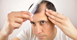 Common Causes of Hair Loss by Dr. FInger_ Hair Restoration Savannah has solutions for Alopecia (3)