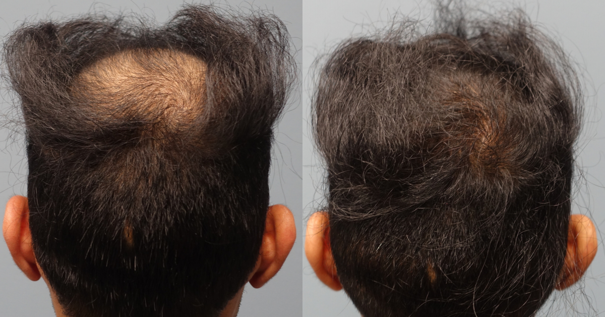 WHY NEOGRAFT HAIR TRANSPLANT_ Hair Loss Solution in Savannah Georgia by Hair Restoration Savannah by Dr Finger (5)