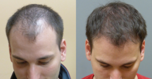 WHY NEOGRAFT HAIR TRANSPLANT_ Hair Loss Solution in Savannah Georgia by Hair Restoration Savannah by Dr Finger (6)