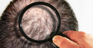 Neograft (FUE) and Strip Method (FUT) Hair Transplant Explained - Dr. Finger in Savannah Georgia- Hair Restoration Savannah (1)