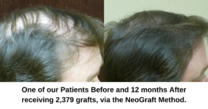 Neograft (FUE) and Strip Method (FUT) Hair Transplant Explained - Dr. Finger in Savannah Georgia- Hair Restoration Savannah (4)