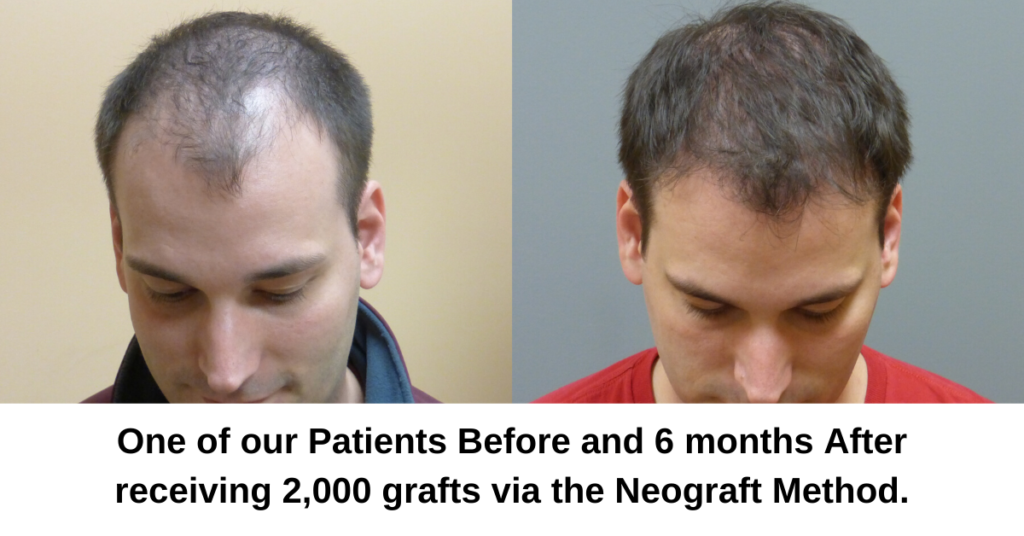 Neograft (FUE) and Strip Method (FUT) Hair Transplant Explained - Dr. Finger in Savannah Georgia- Hair Restoration Savannah (5)