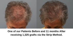 Neograft (FUE) and Strip Method (FUT) Hair Transplant Explained - Dr. Finger in Savannah Georgia- Hair Restoration Savannah (7)